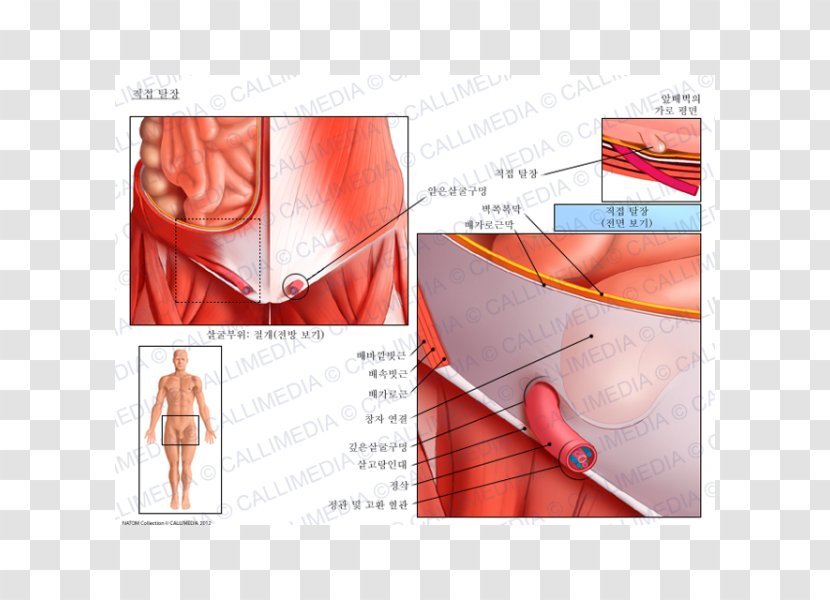 Inguinal Hernia Abdominal External Oblique Muscle Canal Anatomy - Watercolor - Internal Transparent PNG