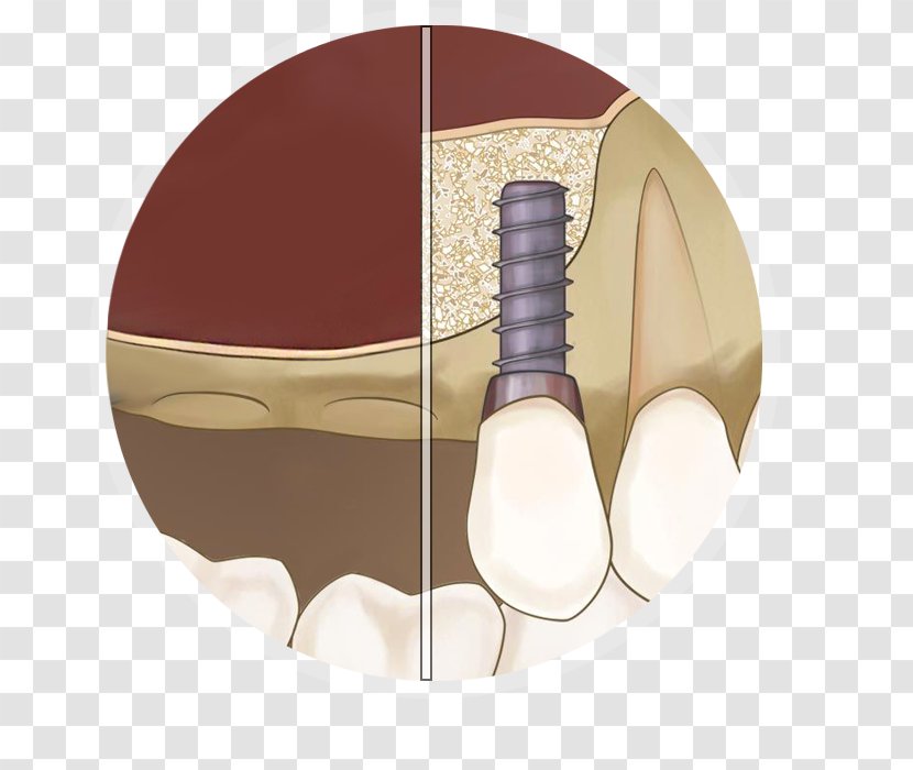Sinus Lift Maxillary Dental Implant Transparent PNG