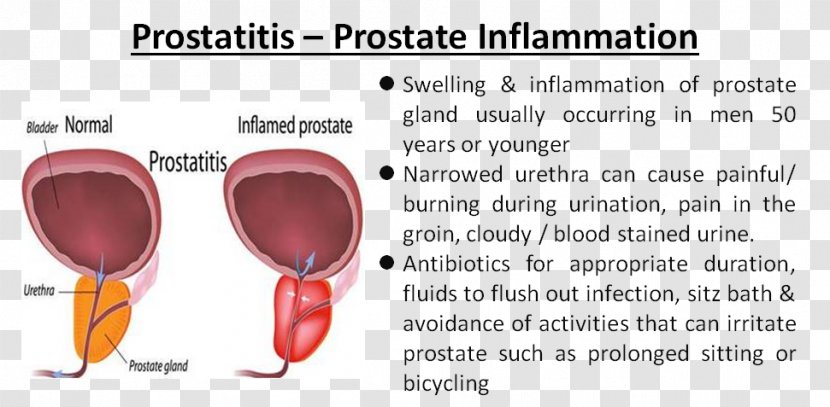 Acute Prostatitis Prostate Benign Prostatic Hyperplasia Urinary Tract Infection - Flower - Gland Transparent PNG