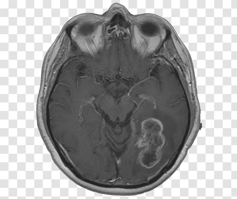 Glioma Glioblastoma Magnetic Resonance Imaging Debulking Malignancy - Frame - Silhouette Transparent PNG