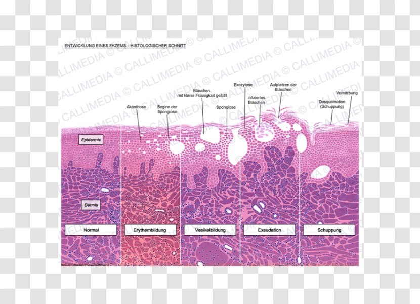 Histology Eczema Dermatitis Skin Corte Histológico - Acanthosis - 360 Degrees Transparent PNG