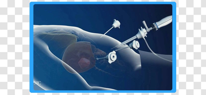 Laparoscopy Laparoscopic Surgery Cancer Intervenție Chirurgicală - Whales Dolphins And Porpoises - Endoscopic Endonasal Transparent PNG
