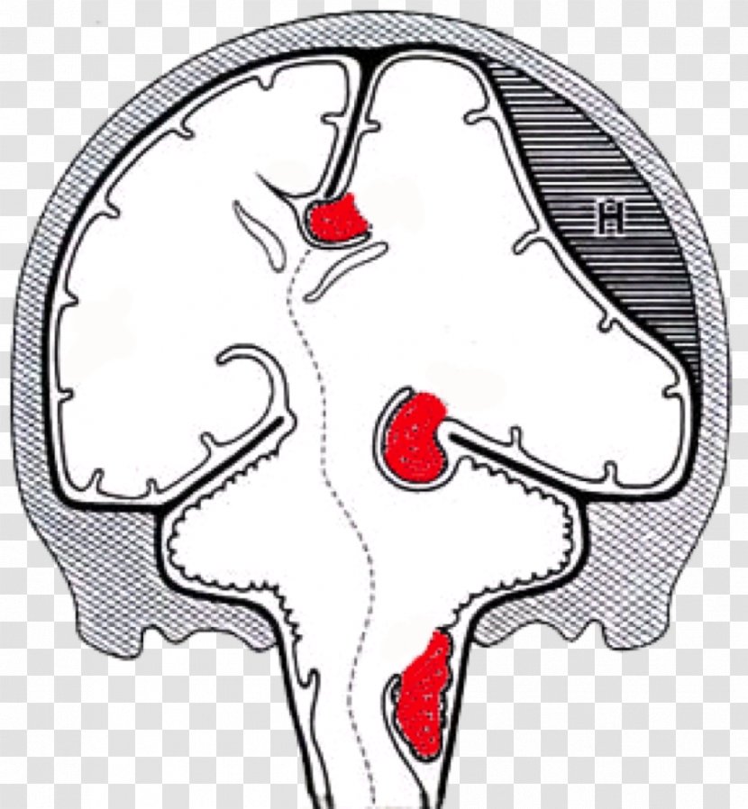 Brain Herniation Intracranial Pressure Uncus - Silhouette Transparent PNG