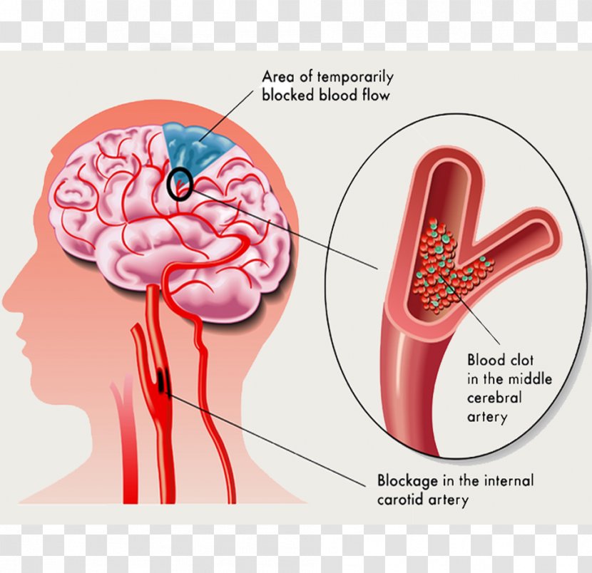 Transient Ischemic Attack Stroke Ischemia Symptom - Frame - Brain Transparent PNG