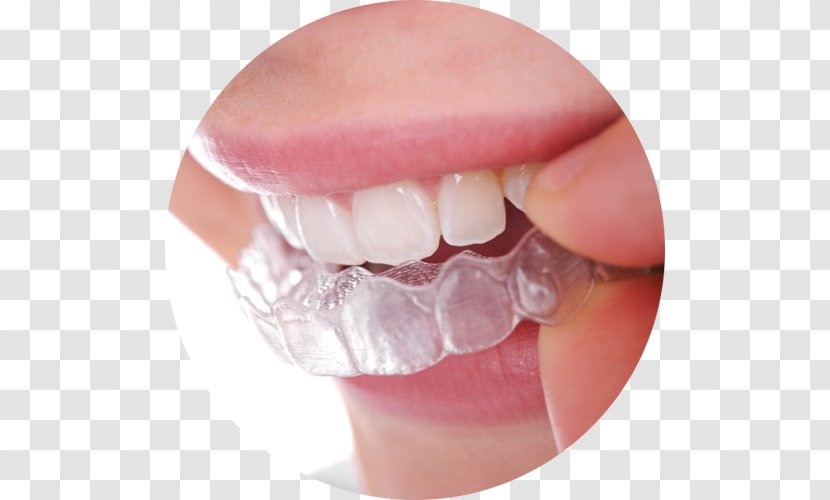 Clear Aligners Dental Braces Dentistry Orthodontics Retainer - Lingual Transparent PNG