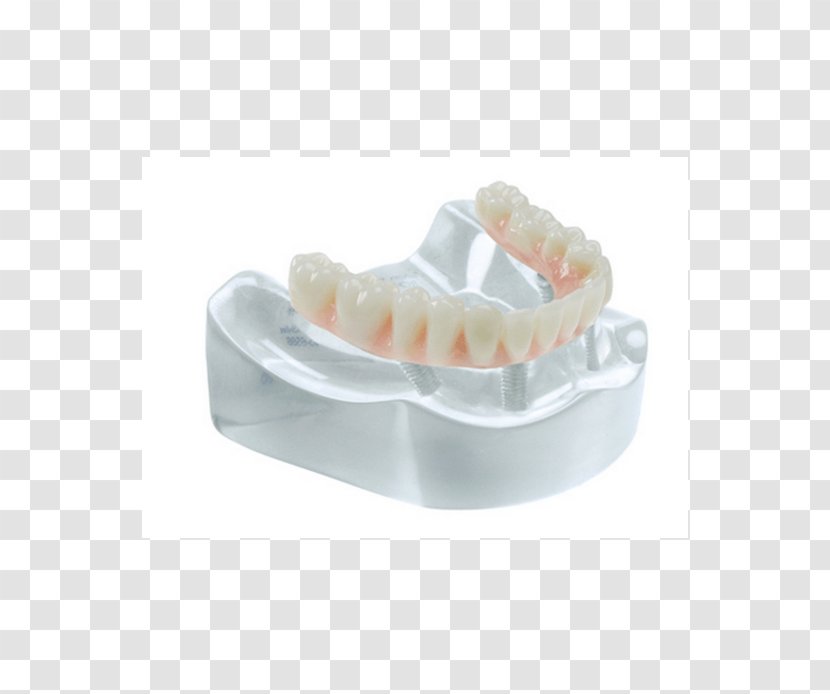 Tooth Bridge Dental Implant Specialty Salvin Specialties - Jaw Transparent PNG