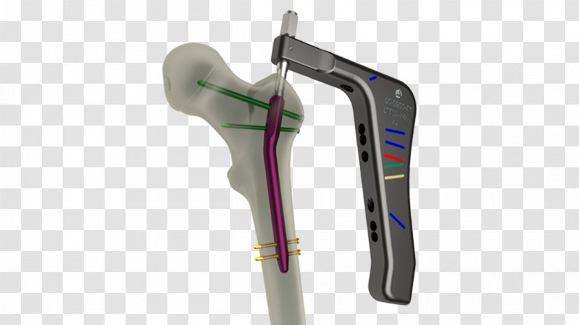 Femur Intramedullary Rod Femoral Fracture Hip Anatomy - Fractures Transparent PNG