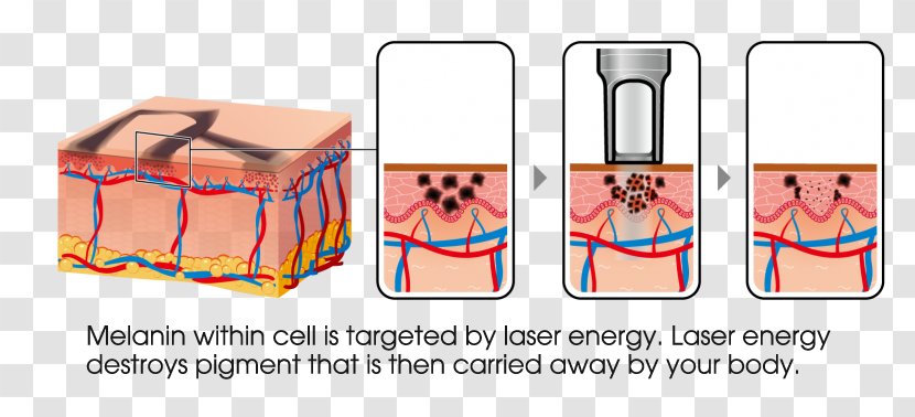 Tattoo Removal Nd:YAG Laser Détatouage - Picosecond - Gradual Discoloration Transparent PNG