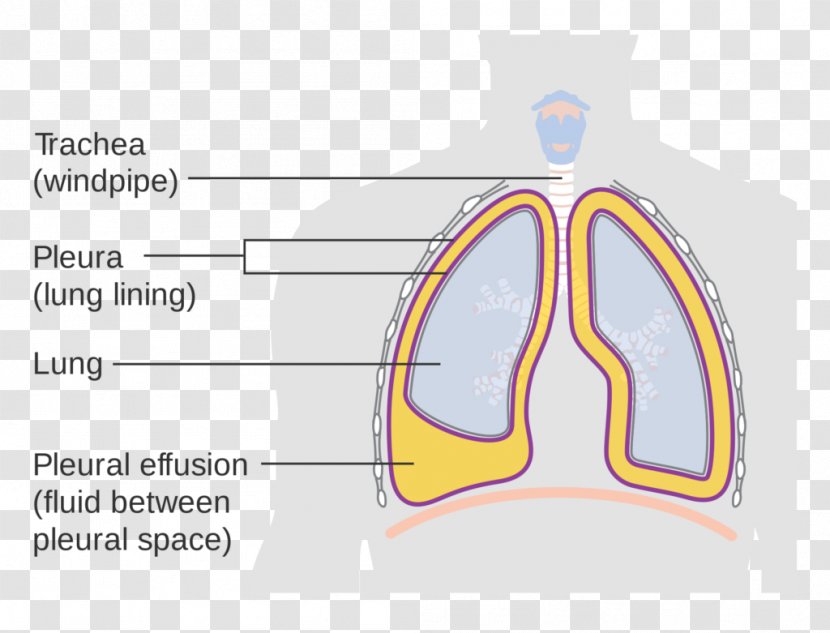 ICD-10 Pleural Effusion Cavity Lung - Heart - Tree Transparent PNG