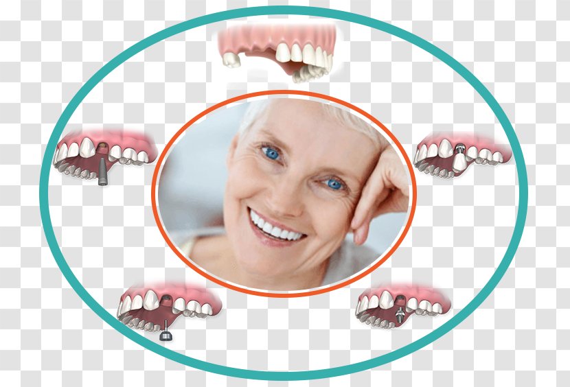 Tooth Dental Implant Jaw All-on-4 - Flower - Cheyne Walk Orthodontics Transparent PNG
