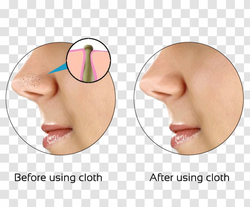 Comedo Skin Nose Exfoliation Pimple - Dandruff Transparent PNG