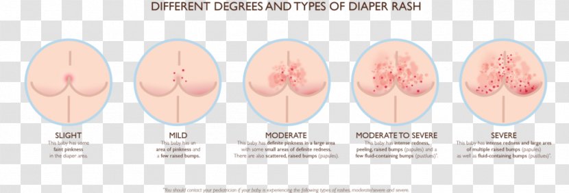 Nail - Mouth - Diaper Dermatitis Transparent PNG
