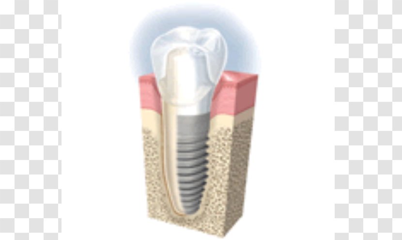 Dental Implant Cosmetic Dentistry Tooth Loss - Human - Crown Transparent PNG