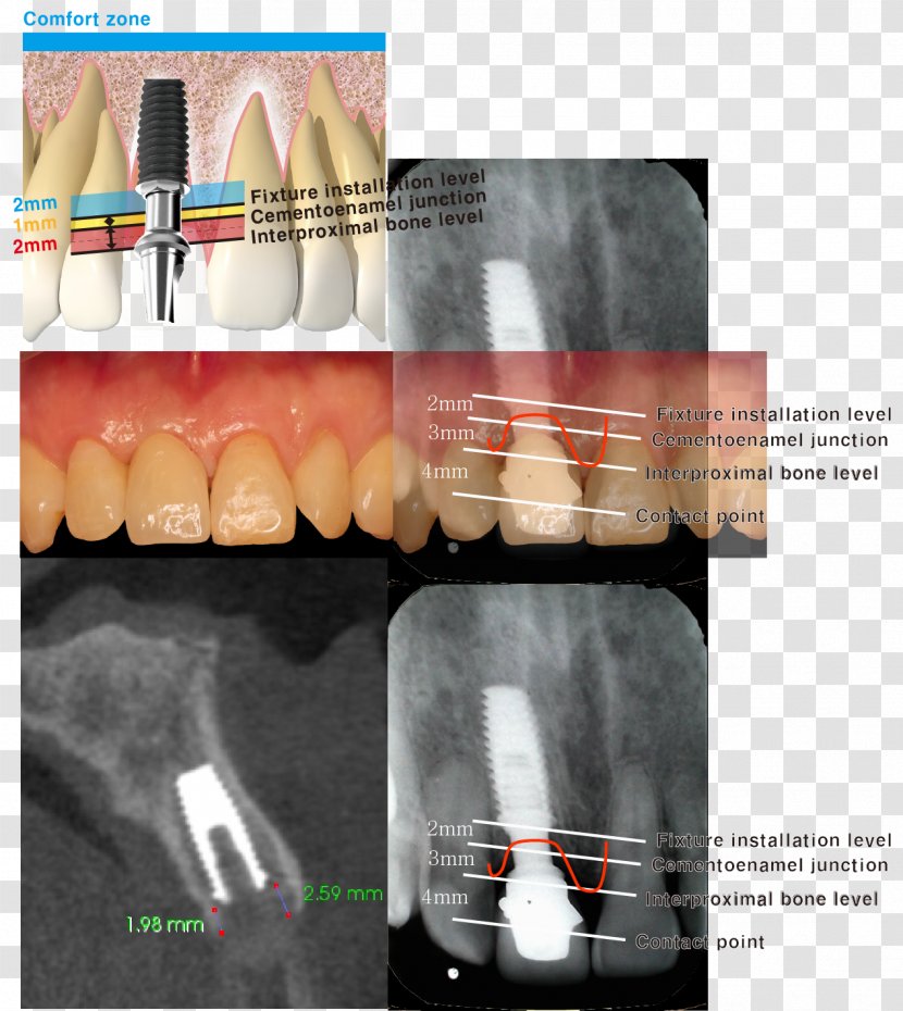 Dental Implant Cementoenamel Junction Tooth Dentistry Maxillary Sinus - Maxilla - Location Board Transparent PNG