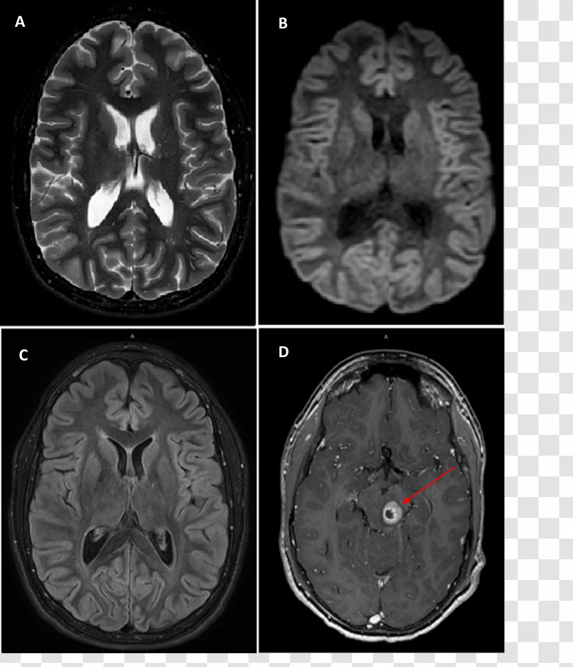 Gadoteric Acid Neurofibromatosis Type II Magnetic Resonance Imaging - Cartoon - Watercolor Transparent PNG