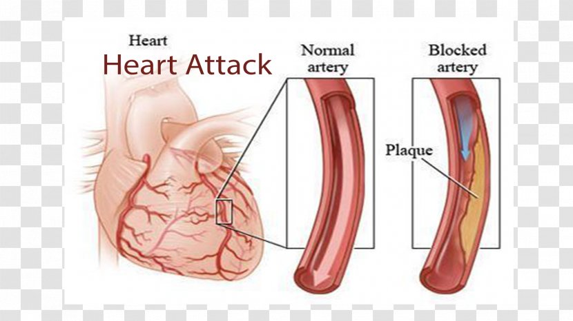Coronary Artery Disease Cardiovascular Myocardial Infarction Cardiology - Silhouette - Heart Transparent PNG