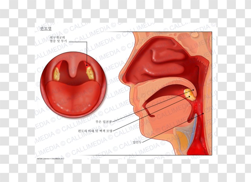 Tonsillitis Otorhinolaryngology Oropharynx Oropharyngeal Cancer - Ear - Nose Transparent PNG