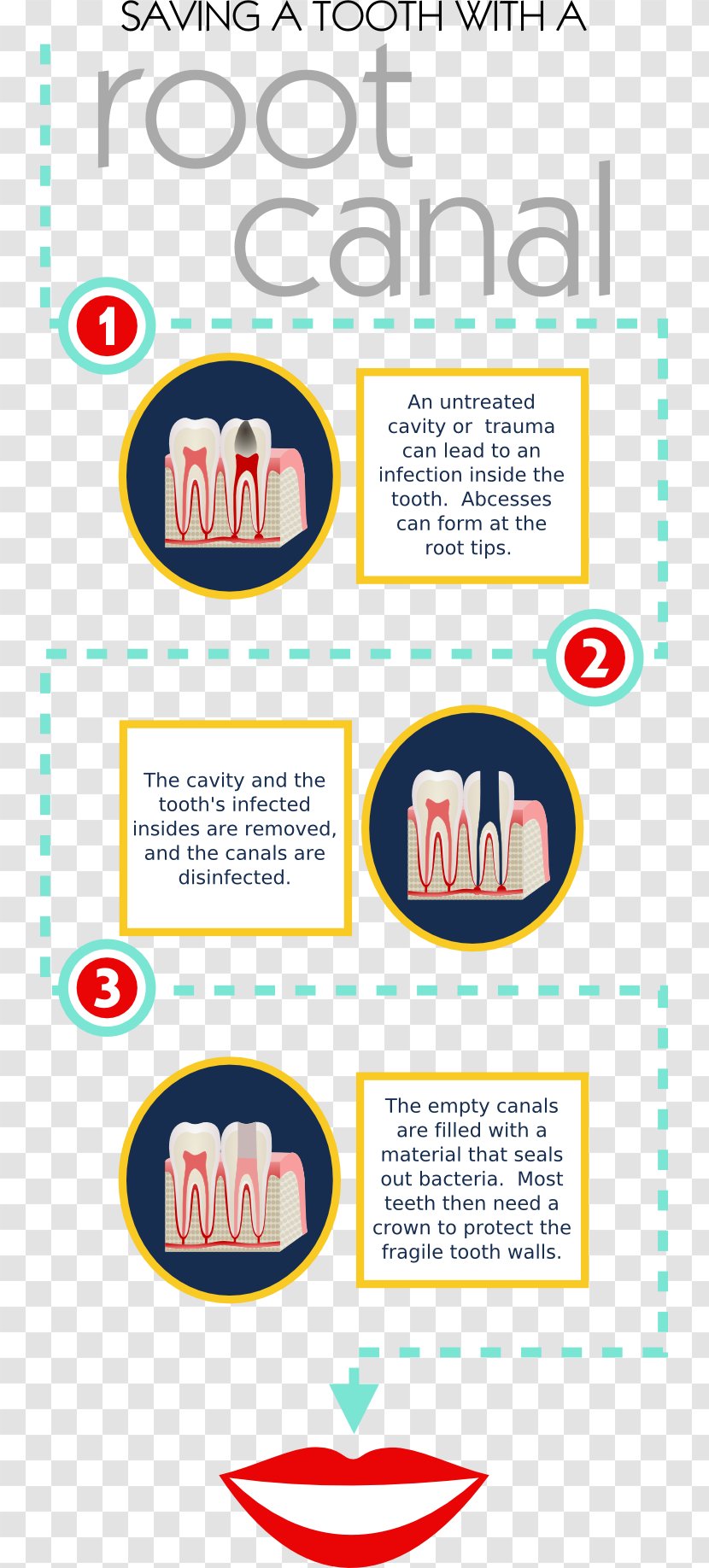 Bridge Dentistry Dental Restoration Crown Implant - Amalgam - Endodontic Therapy Transparent PNG