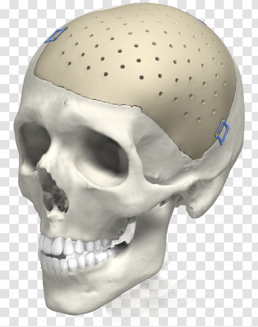 Implant Skull 3D Printing Karl Leibinger Medizintechnik GmbH & Co. KG Surgery Transparent PNG