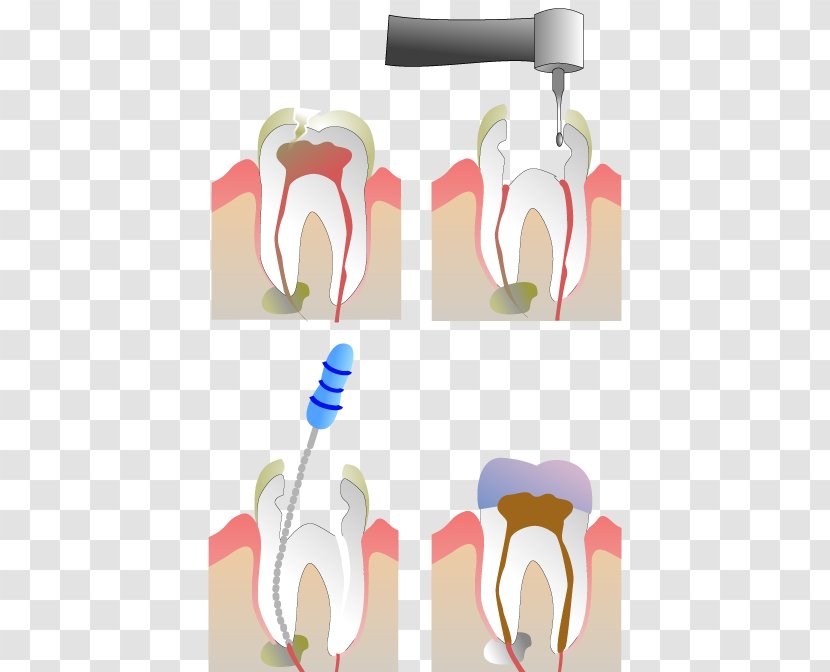 Endodontic Therapy Root Canal Dentistry - Cartoon - Endodoncia Transparent PNG