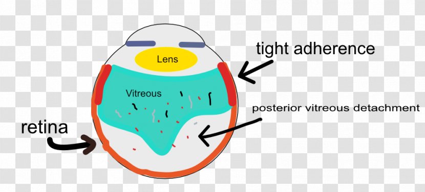 Posterior Vitreous Detachment Floater Body Retina Photopsia - Watercolor - Eye Transparent PNG