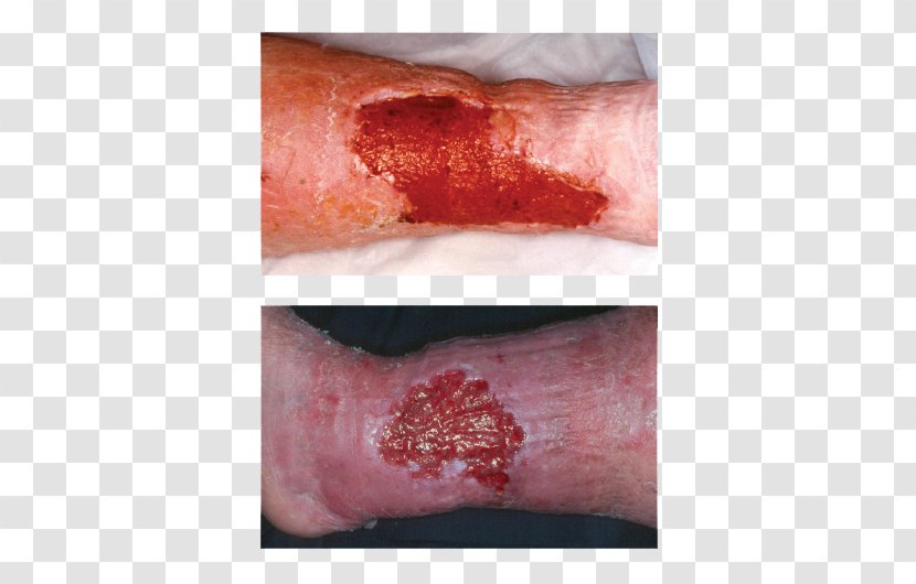 Wound Healing Inflammation Dressing - Tree - Wounds Transparent PNG