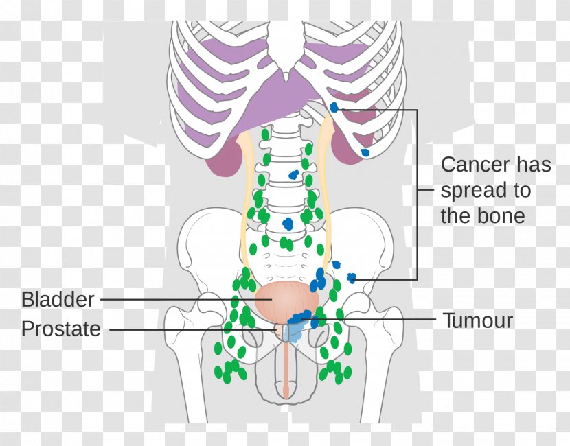 Prostate Cancer Lymph Node Metastasis Prostate-specific Antigen - Watercolor - Lycopene Lowers Risk Of Transparent PNG