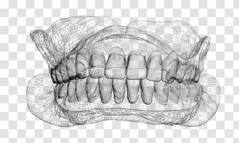 Overdentures Sketch Veneer - Dental Laboratory Transparent PNG