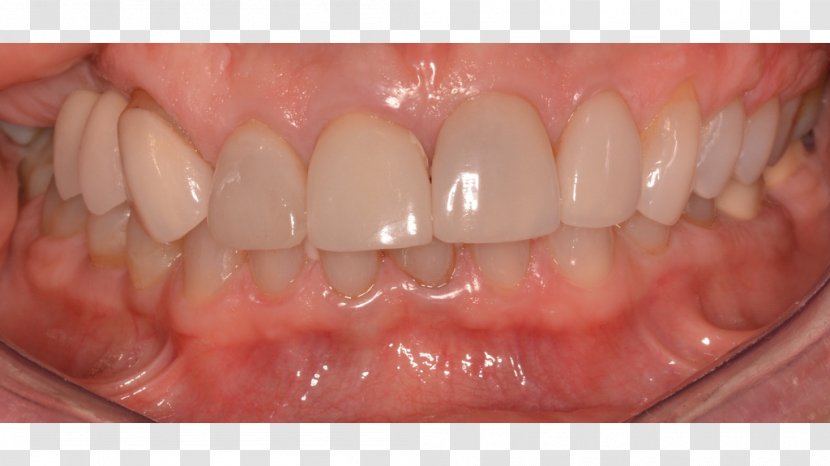 Human Tooth Cosmetic Dentistry Veneer - New Haven Transparent PNG