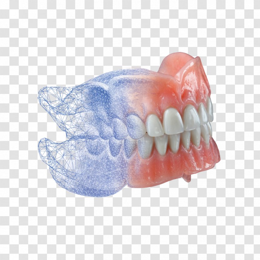 Dentures Dentistry Dental Laboratory Implant - Luminous Transparent PNG