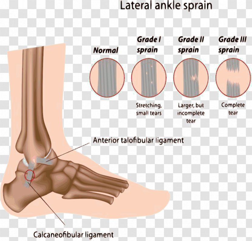 Sprained Ankle High Sprain Injury - Tree - Chiropody Treatment Transparent PNG