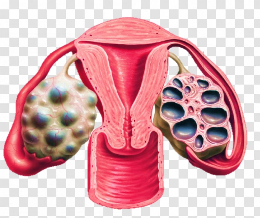 Polycystic Ovary Syndrome Ovarian Cyst Disease - Cartoon - Surgical Tools Transparent PNG