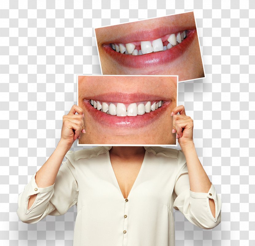 Smile Tooth Whitening Endodontic Therapy Dental Braces Dentistry Transparent PNG