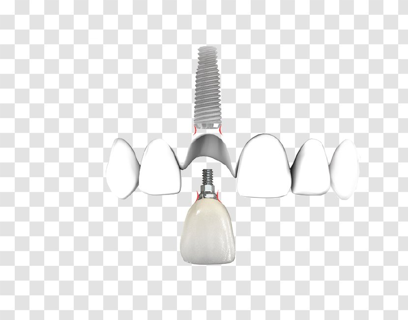 Dentistry Dental Implant Product Design - Service - Implants Bridge Transparent PNG