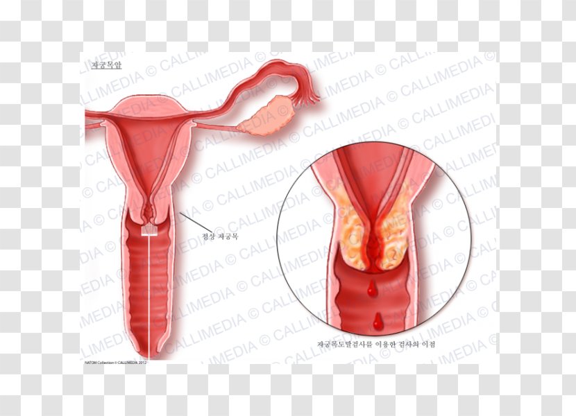 Cervical Cancer Uterine Cervix Uterus - Utero Transparent PNG