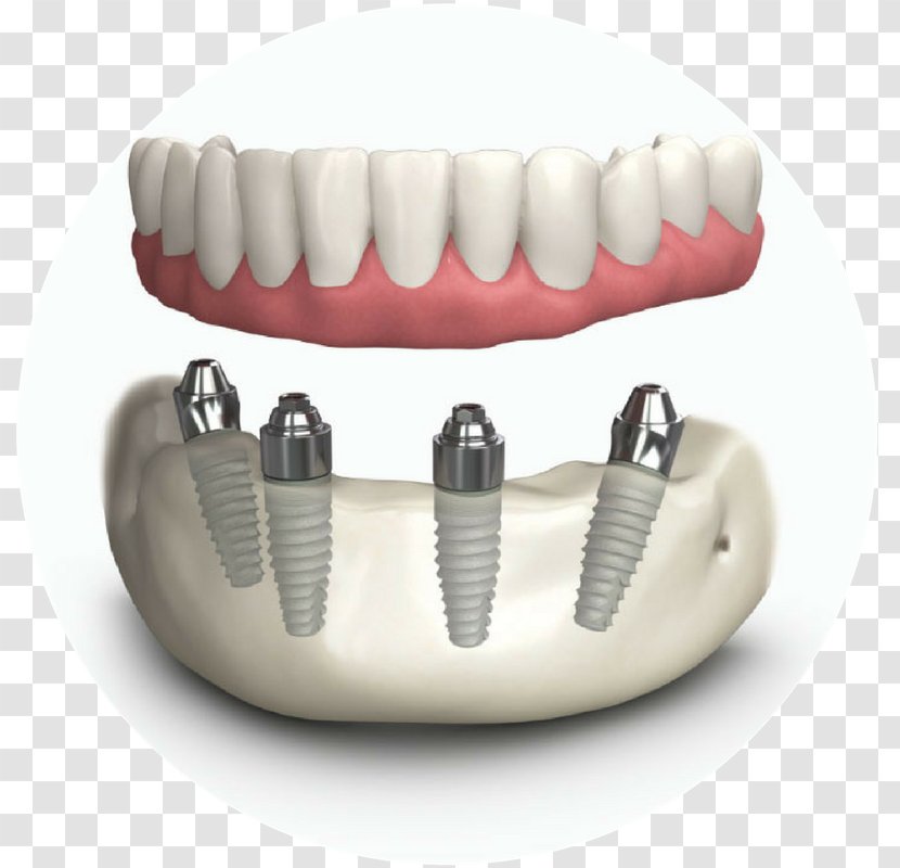 Tooth Dentures Dental Implant Dentistry - Laboratory Transparent PNG