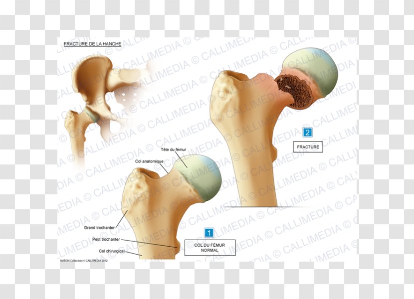 Hip Fracture Shoulder Bone Femur - Silhouette - Fractures Transparent PNG