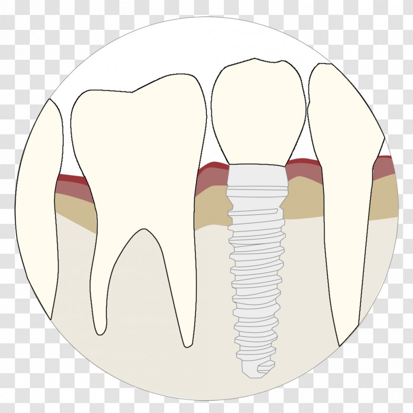 Tooth Velopex International Dentistry Dental Implant Abrasion - Cartoon - Augmentation Transparent PNG
