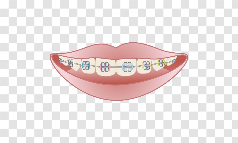矯正歯科 Dentistry Dental Braces Mouthguard Transparent PNG