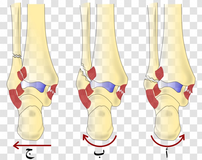 Danis–Weber Classification Ankle Fracture Lauge-Hansen Bone Malleolus - Arm - Webber Books Transparent PNG