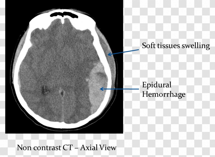 Computed Tomography Of The Head Brain Epidural Hematoma Cerebral Hemorrhage - Frame Transparent PNG