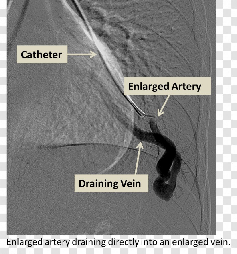 Cerebral Arteriovenous Malformation Lung Embolization Angiography - Artery - Pulmonary Vein Transparent PNG