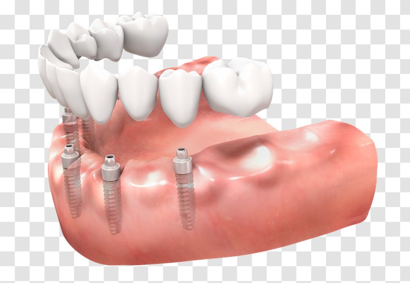 Tooth Dentures Dental Implant Implantology - Cosmetic Dentistry - Bridge Transparent PNG