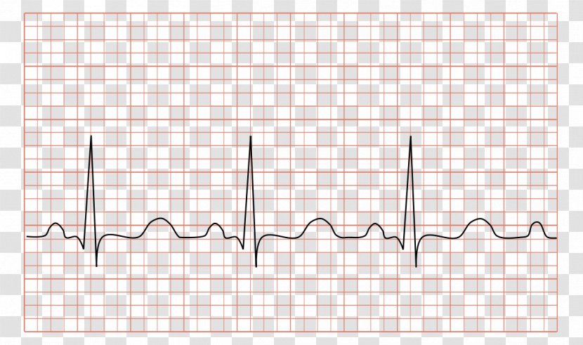 Electrocardiography Tachycardia Heart Rate Cardiology - Cartoon - Chang E Transparent PNG