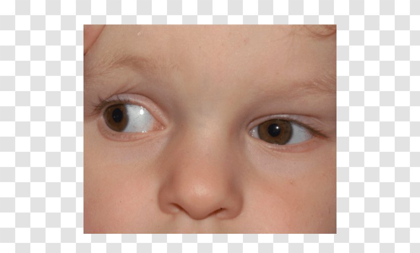 Duane Syndrome Eye Movement Differential Diagnosis Transparent PNG