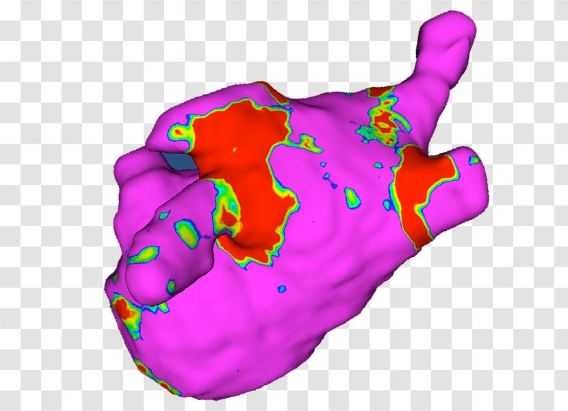 Atrial Fibrillation Heart Arrhythmia Flutter Paroxysmal Tachycardia Transparent PNG