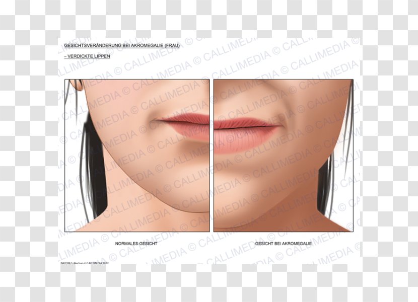 Acromegaly Face Diabetes Mellitus Lip Surgery - Gloss Transparent PNG