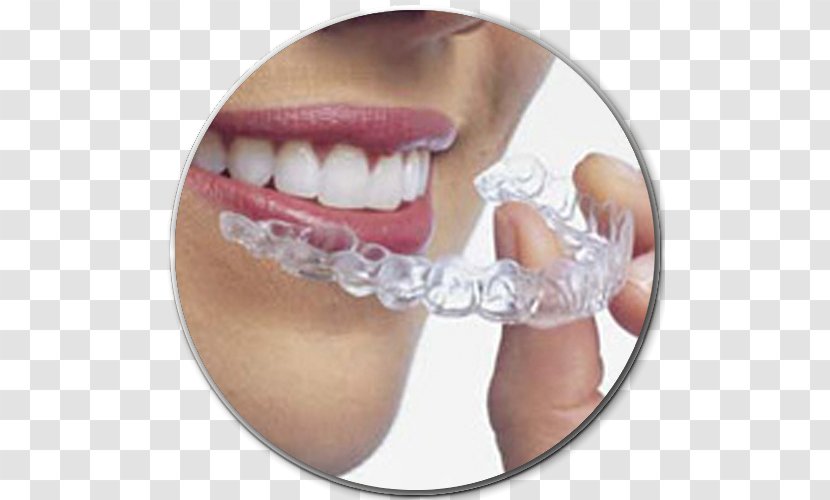 Clear Aligners Dental Braces Orthodontics Dentistry Therapy - Finger - Health Transparent PNG