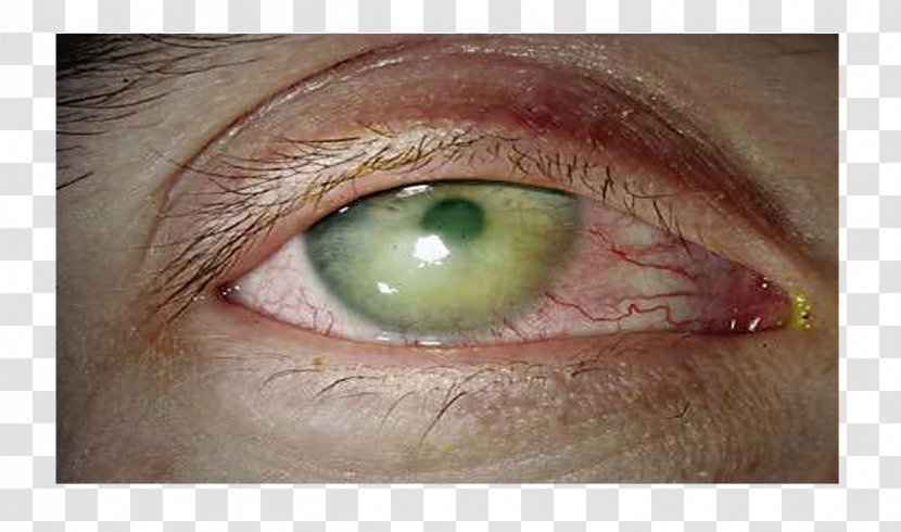 Iris Dry Eye Syndrome Corneal Abrasion - Flower - Eyelids Transparent PNG