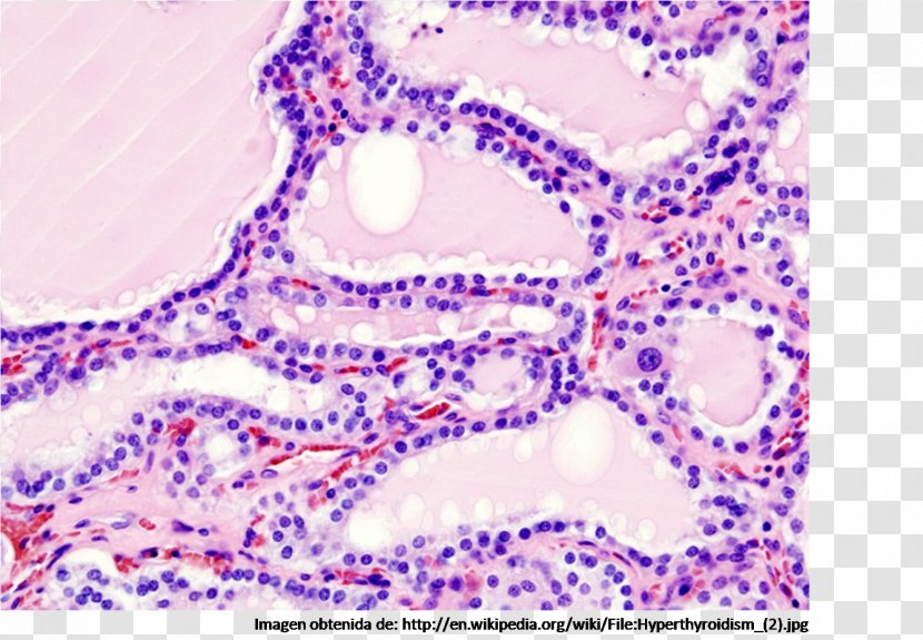 Graves' Disease Hyperthyroidism Biopsy - Autoimmunity - Thyroid Transparent PNG
